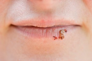 Herpes labial
