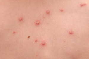 herpes zoster